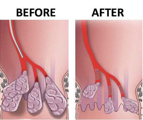 Comparison before HEMO and after